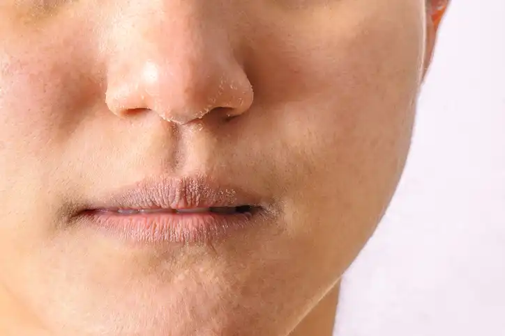 How Can We Treat Lip Hemangioma?
