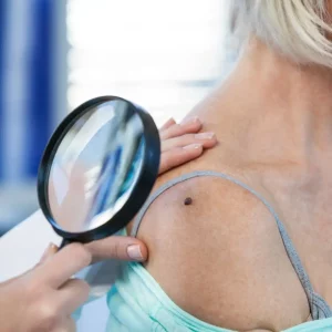 Skin tags or extra skin growths should always be checked by a dermatologist in case it may lead to skin cancer. Contact our dermatologists in Calgary for an appointment.