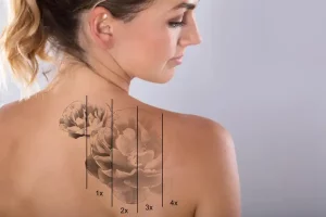Visit our Medispa in Calgary for Tattoo removal using laser treatment.