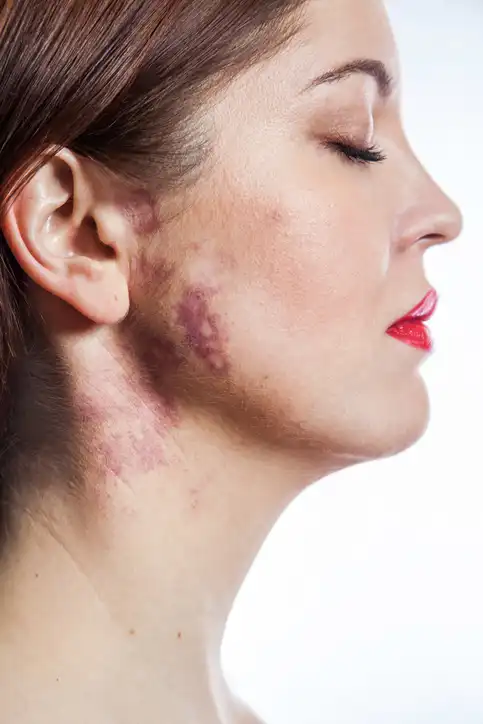 What Can Be Done to Address Scars or Birthmarks on the Skin?