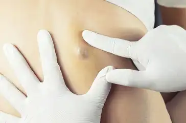 What is a pilar cyst and should I remove it?