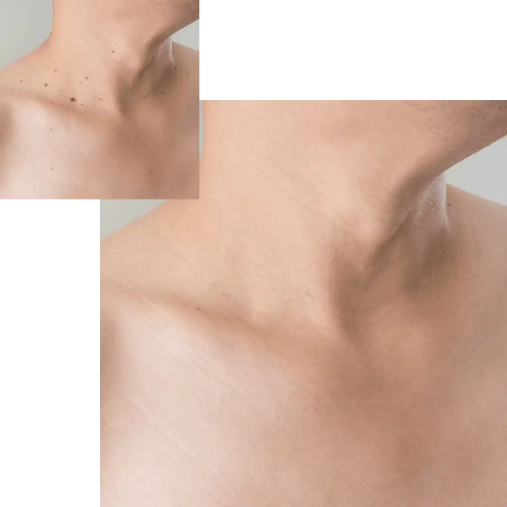 A before and after to spot the difference in a woman’s skin after undergoing treatments to reduce skin lesions at our Medispa and advanced skin care clinic in Calgary.