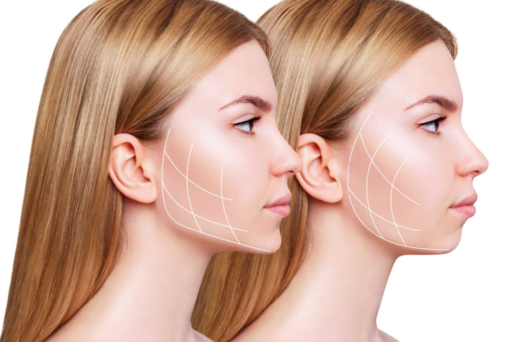 A young woman's face resculpted to reduce chin fat and give her a more defined and sharp jawline.