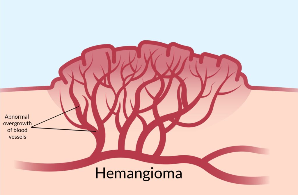 An illustration of what hemangiomas look like with overgrowth of blood vessels under the skin.