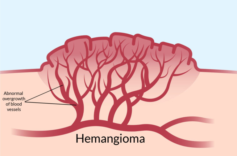 What Is A Vascular Birthmark Calgary