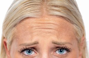 A closeup of a woman's forehead showing her frown lines.