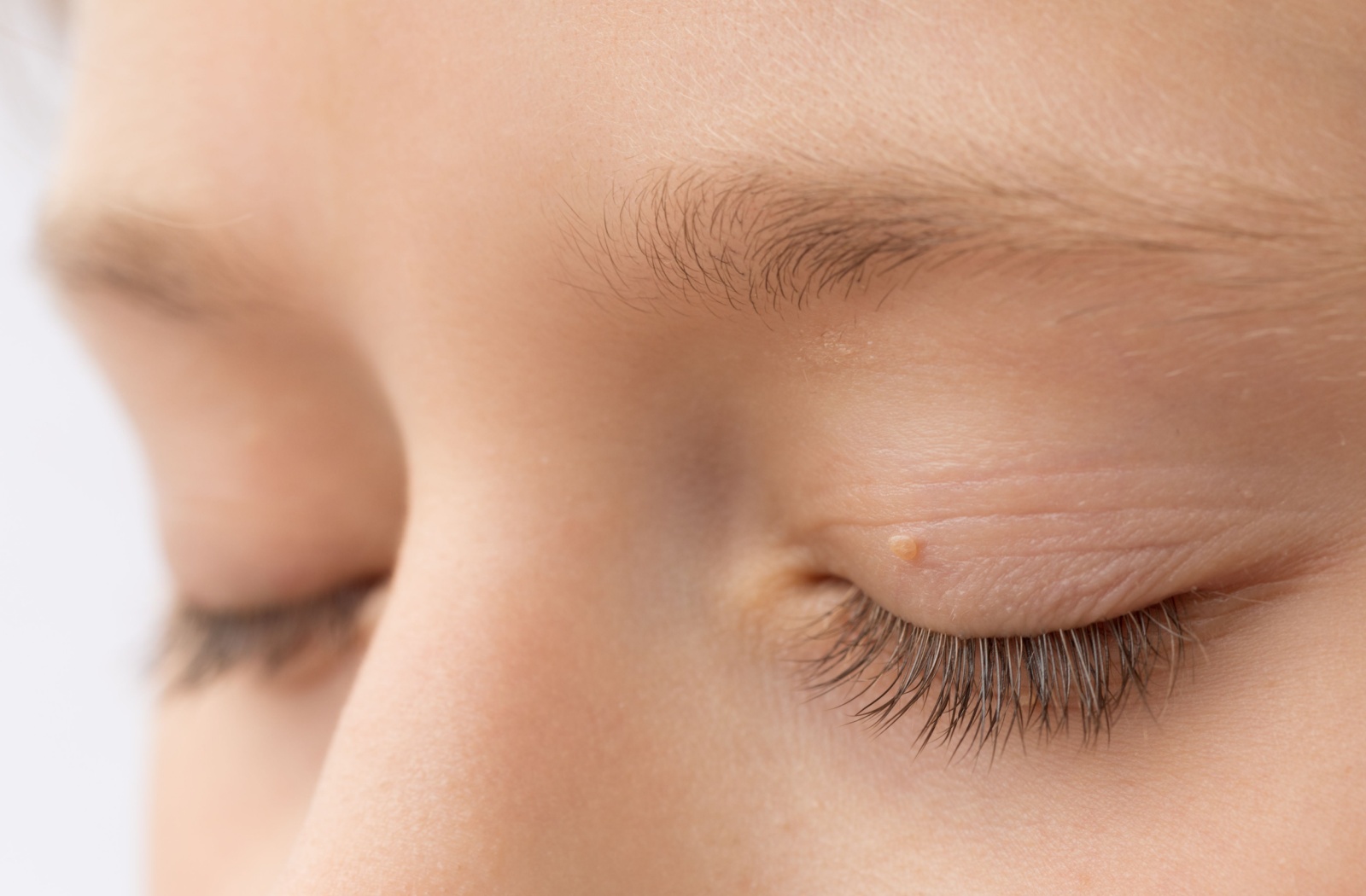 A close-up of a person's closed eyelids, with a skin tag on the left eyelid.