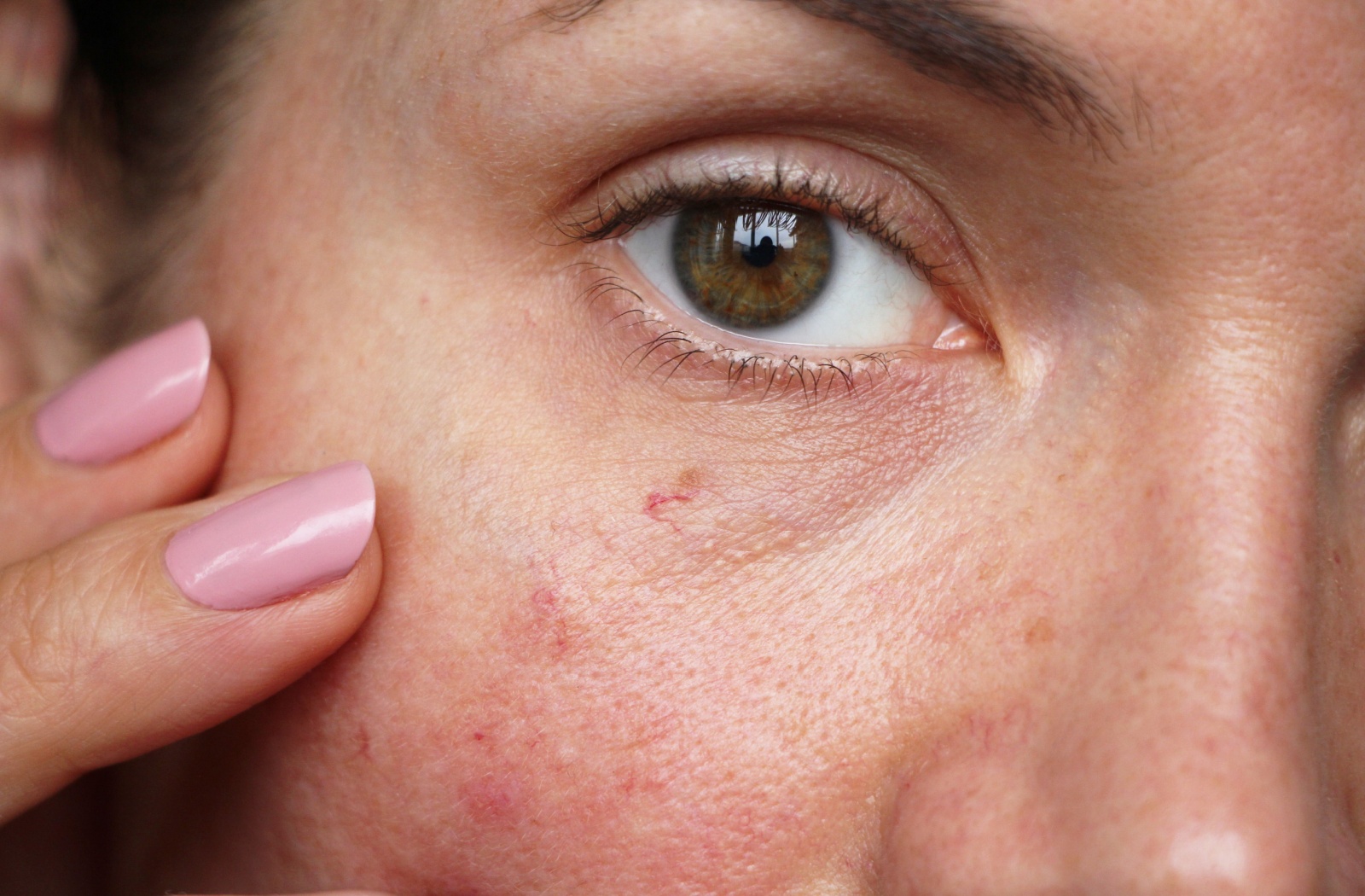 A close-up photo of facial telangiectasia, visible in the area under the eye