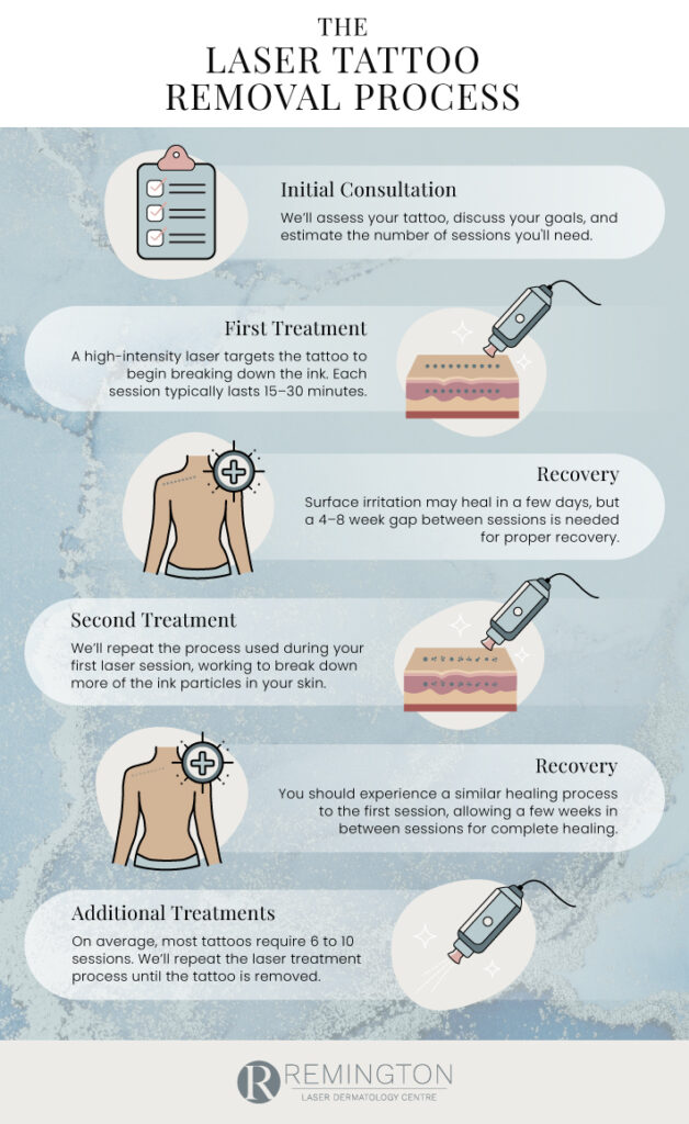 An infographic explaining all the steps involved in tattoo removal.