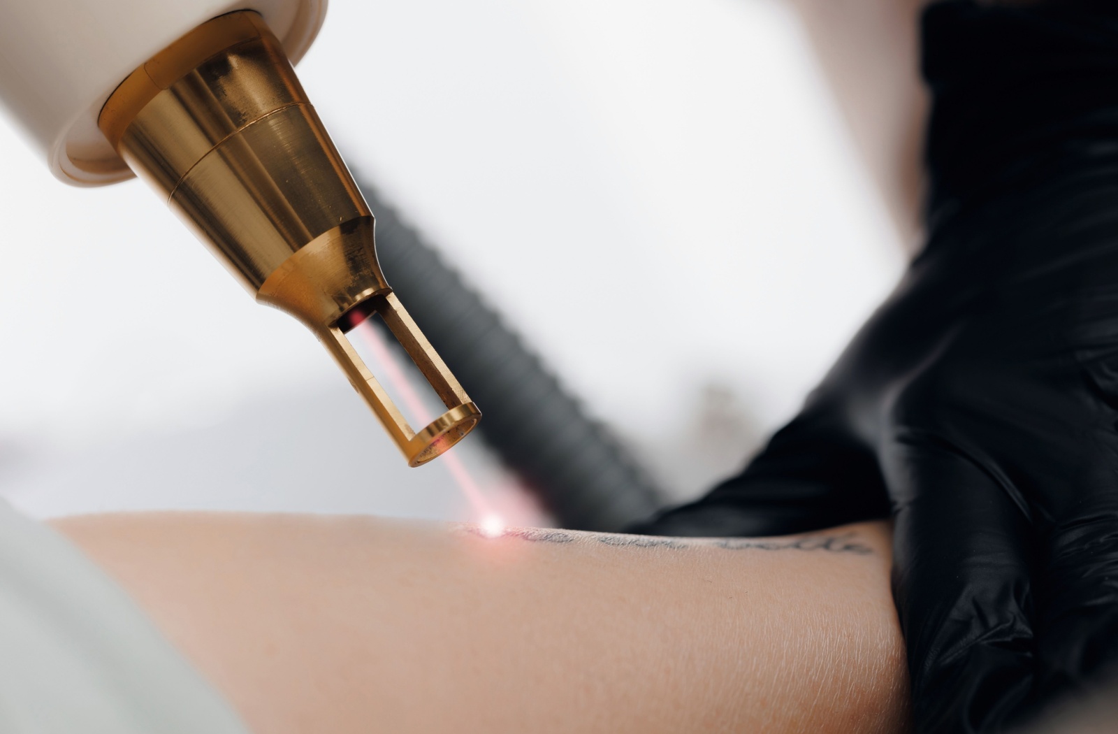 Close-up of a gold-tipped laser pointed at a tattoo on a person's forearm to remove it. A dermatologist wearing black medical gloves holds the arm in place.