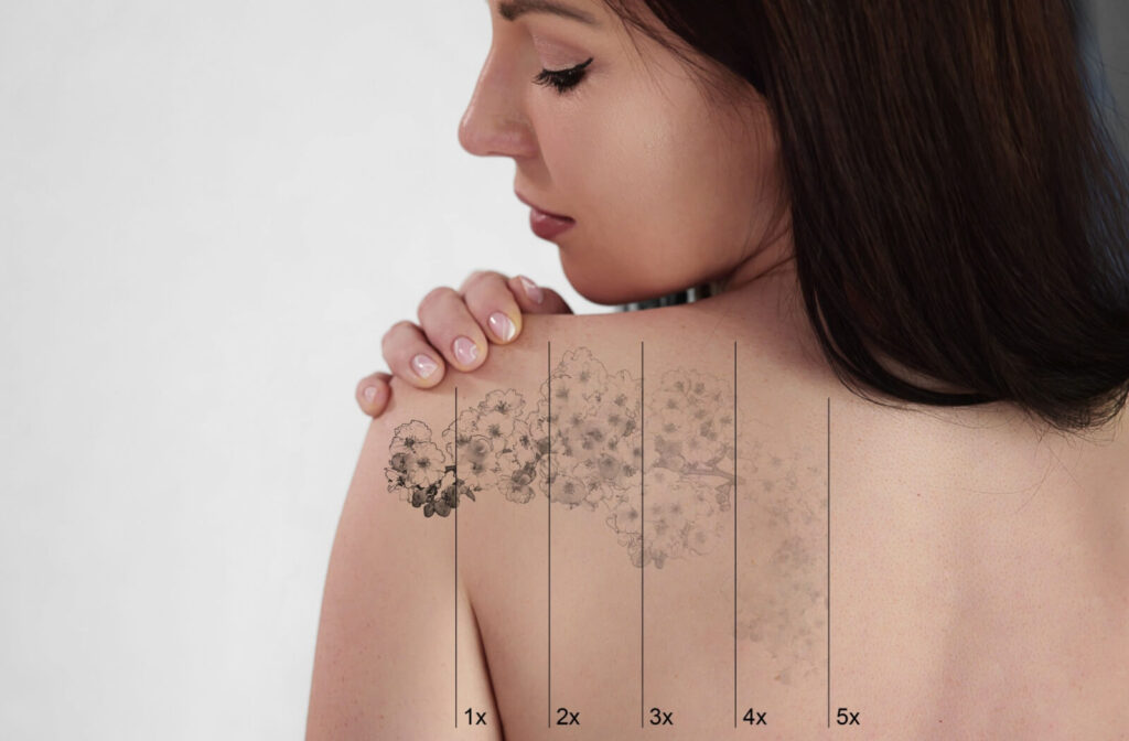 Visual of a floral tattoo on a person's back fading over time with lines showing the difference after 1, 2, 3, 4, and 5 sessions of laser tattoo removal.