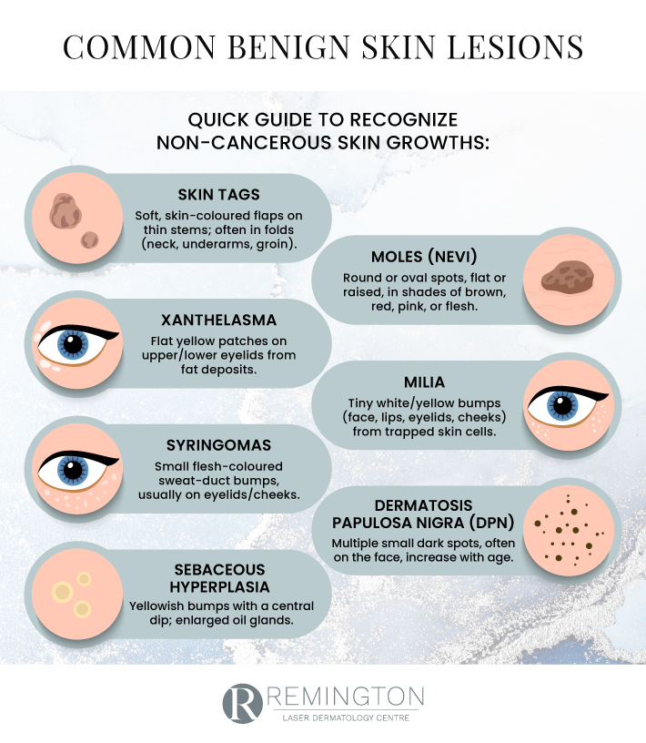Infographic that shows you how to recognize common types of benign skin lesions